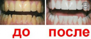 Профессиональная гигиена полости рта цены